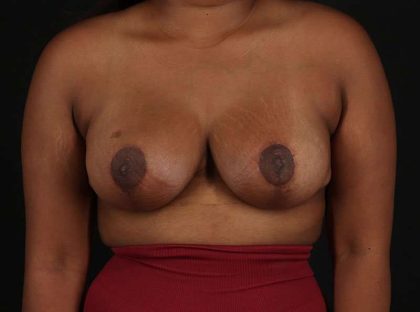 Breast Reduction Before & After Patient #2729