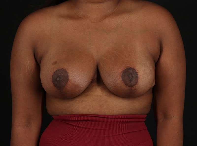 Breast Reduction Before & After Patient #2729