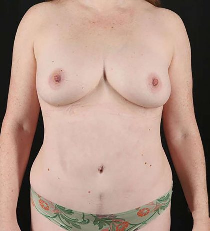 Abdominoplasty (Tummy Tuck) Before & After Patient #801