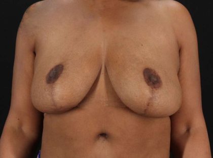 Breast Reduction Before & After Patient #2777