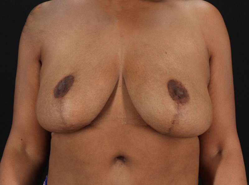 Breast Reduction Before & After Patient #2777