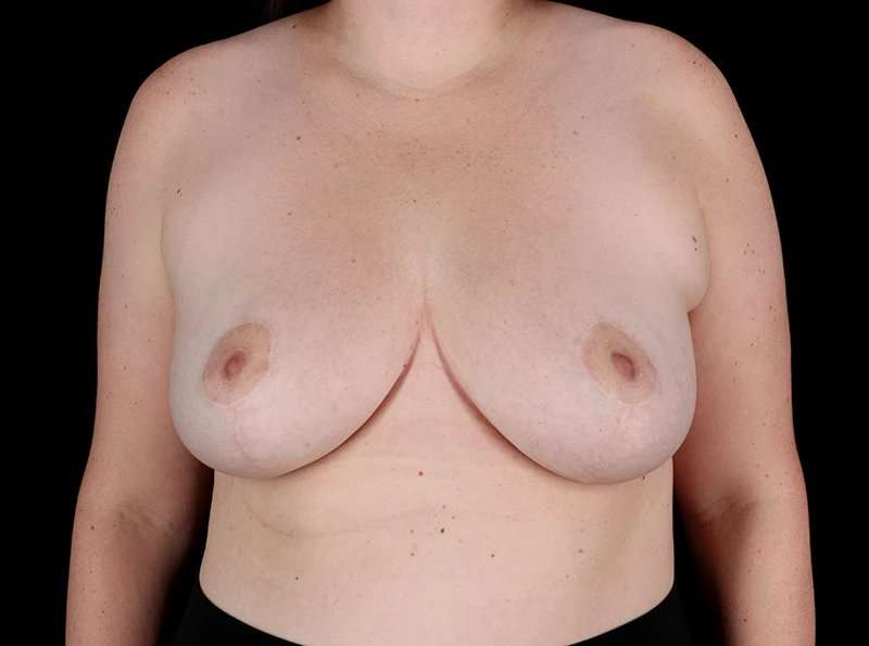 Breast Reduction Before & After Patient #2802