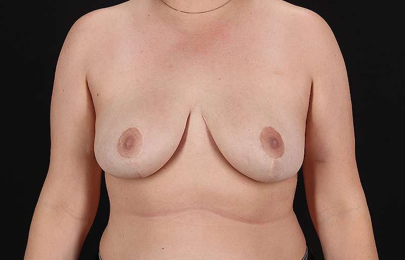 Breast Reduction Before & After Patient #2813
