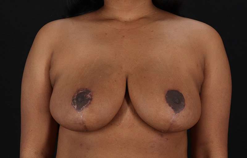 Breast Reduction Before & After Patient #2824