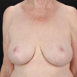 Breast Reduction Before & After Patient #2836