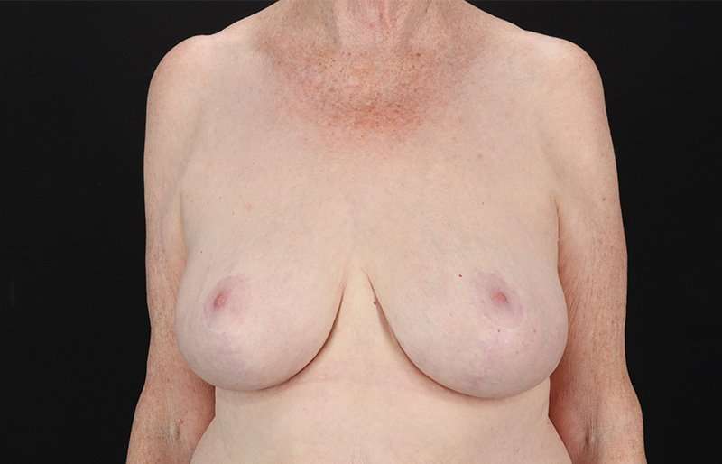 Breast Reduction Before & After Patient #2836