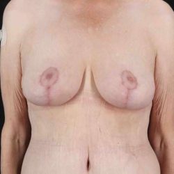 Breast Reduction Before & After Patient #2847