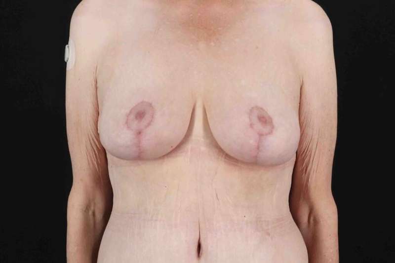 Breast Reduction Before & After Patient #2847
