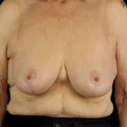 Breast Reduction Before & After Patient #2859