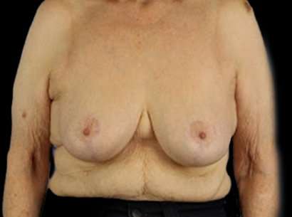 Breast Reduction Before & After Patient #2859