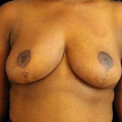 Breast Reduction Before & After Patient #2870