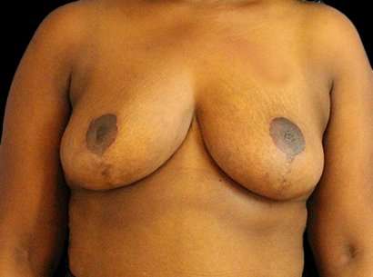 Breast Reduction Before & After Patient #2870