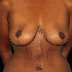 Breast Reduction Before & After Patient #2881
