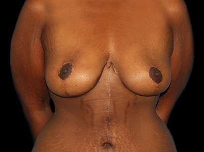 Breast Reduction Before & After Patient #2881