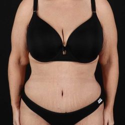 Abdominoplasty (Tummy Tuck) Before & After Patient #817
