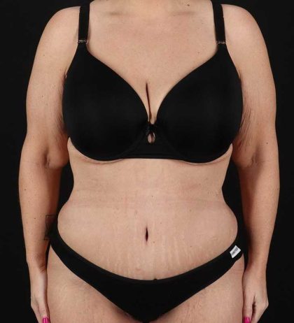 Abdominoplasty (Tummy Tuck) Before & After Patient #817