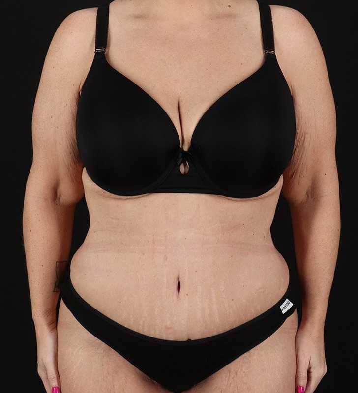 Abdominoplasty (Tummy Tuck) Before & After Patient #817