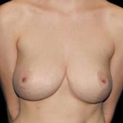 Breast Reduction Before & After Patient #2888