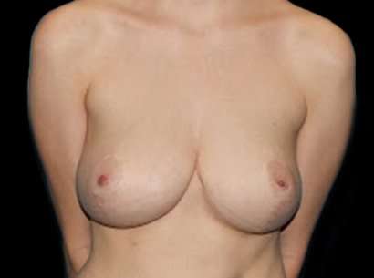 Breast Reduction Before & After Patient #2888