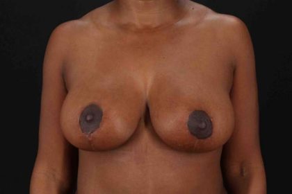 Breast Reduction Before & After Patient #2899