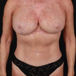 All Me Augmentation Before & After Patient #2921