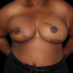 DIEP Flap Before & After Patient #2930