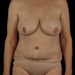 DIEP Flap Before & After Patient #2943