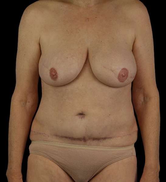 DIEP Flap Before & After Patient #2943