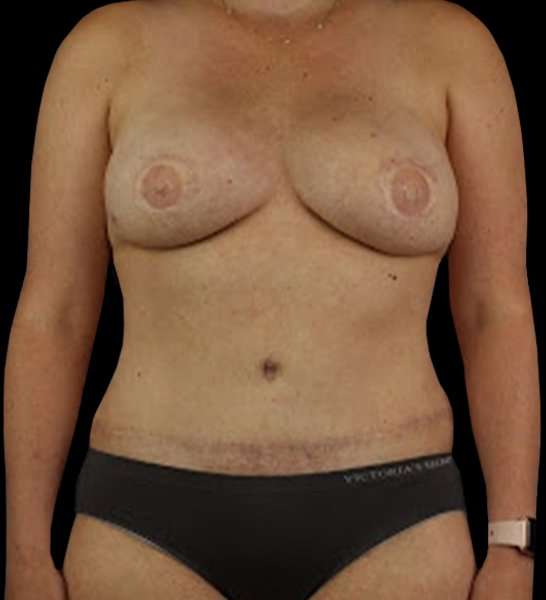 DIEP Flap Before & After Patient #2954