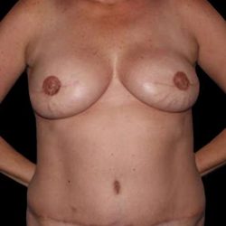 DIEP Flap Before & After Patient #2962
