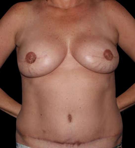 DIEP Flap Before & After Patient #2962