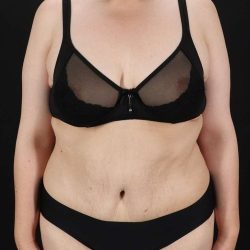 Abdominoplasty (Tummy Tuck) Before & After Patient #830