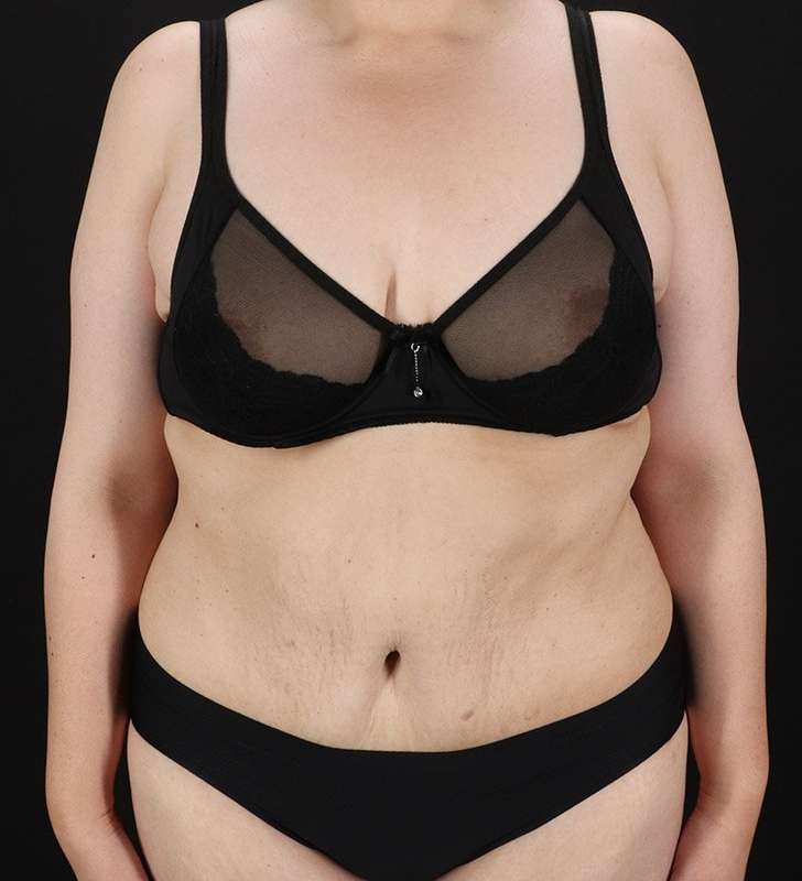 Abdominoplasty (Tummy Tuck) Before & After Patient #830