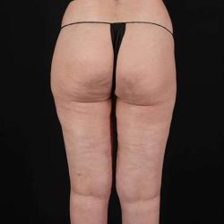 Cellulite Treatment Before & After Patient #546