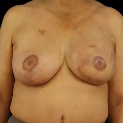 DIEP Flap Before & After Patient #3030