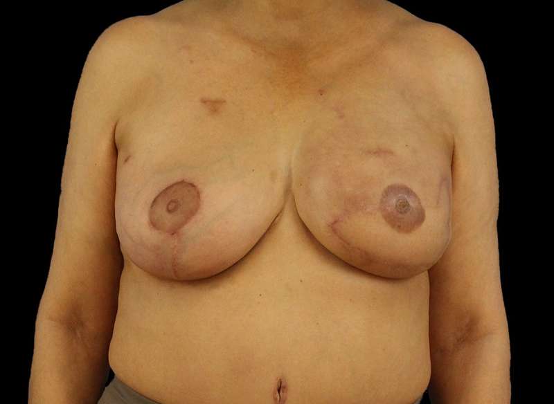 DIEP Flap Before & After Patient #3030
