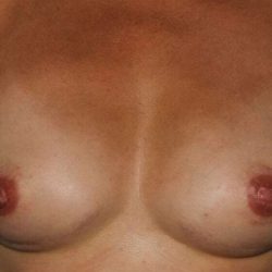 DIEP Flap Before & After Patient #3033