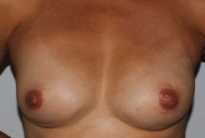 DIEP Flap Before & After Patient #3033