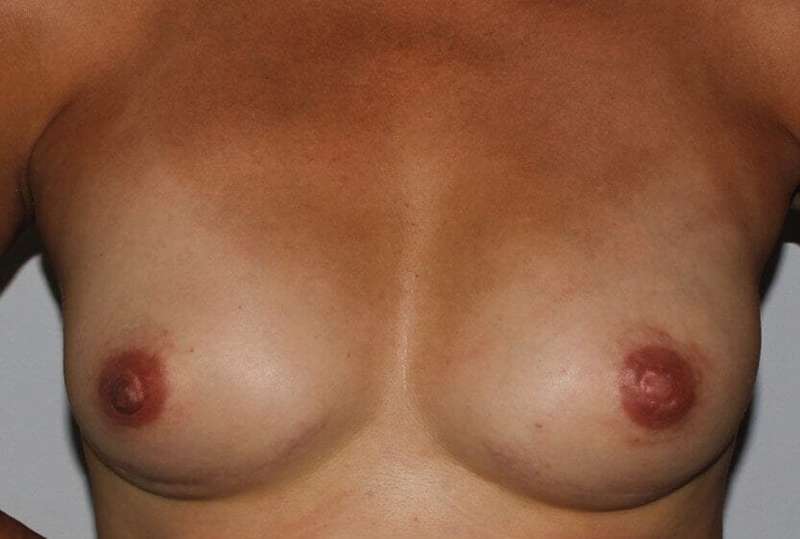DIEP Flap Before & After Patient #3033