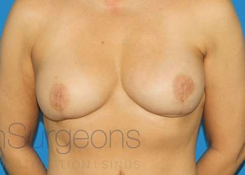 DIEP Flap Before & After Patient #3036