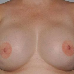 DIEP Flap Before & After Patient #3039