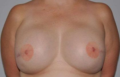 DIEP Flap Before & After Patient #3039