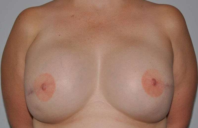 DIEP Flap Before & After Patient #3039