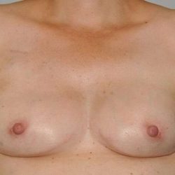 DIEP Flap Before & After Patient #3049
