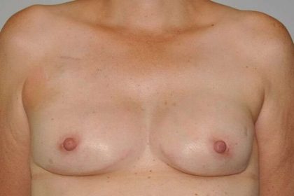 DIEP Flap Before & After Patient #3049