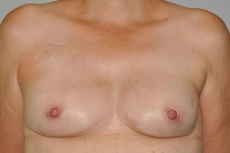 DIEP Flap Before & After Patient #3049