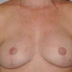 DIEP Flap Before & After Patient #3052