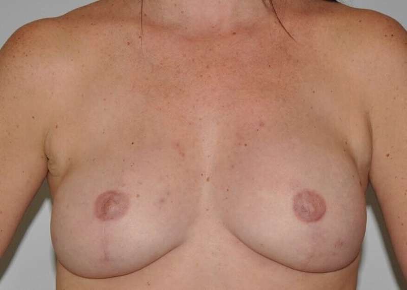 DIEP Flap Before & After Patient #3052