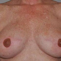 DIEP Flap Before & After Patient #3058