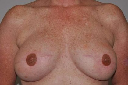 DIEP Flap Before & After Patient #3058